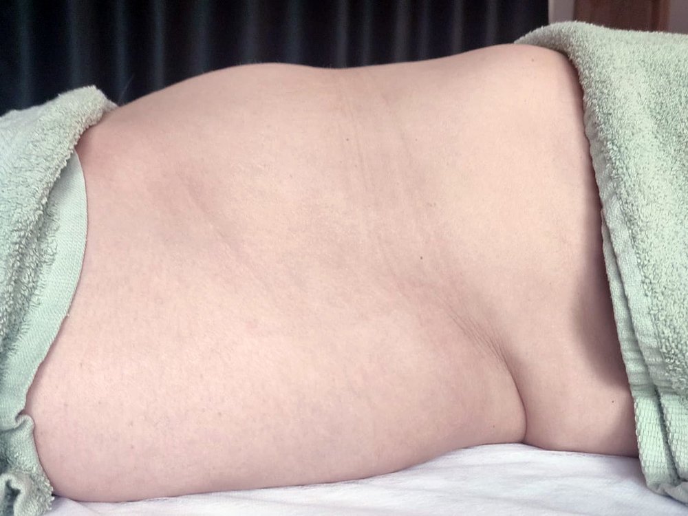Lymfoshaping – efekt procedúry, foto 1